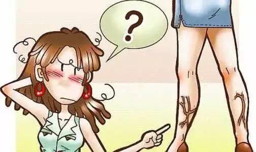 健康 | 到底啥是静脉曲张?