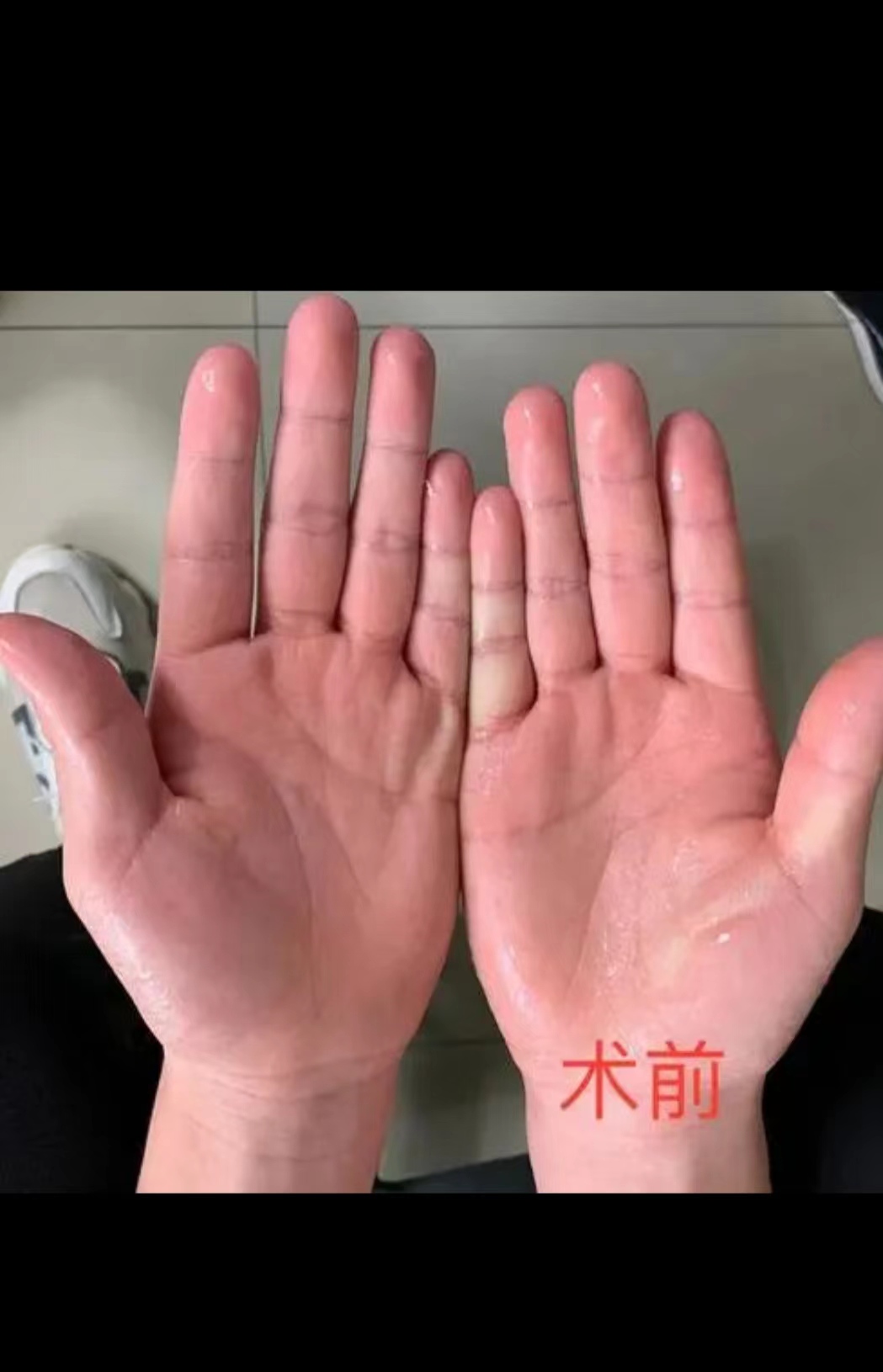 微创手术，消除手上多汗烦恼丨我院成功开展胸腔镜下双侧R4交感神经阻断术